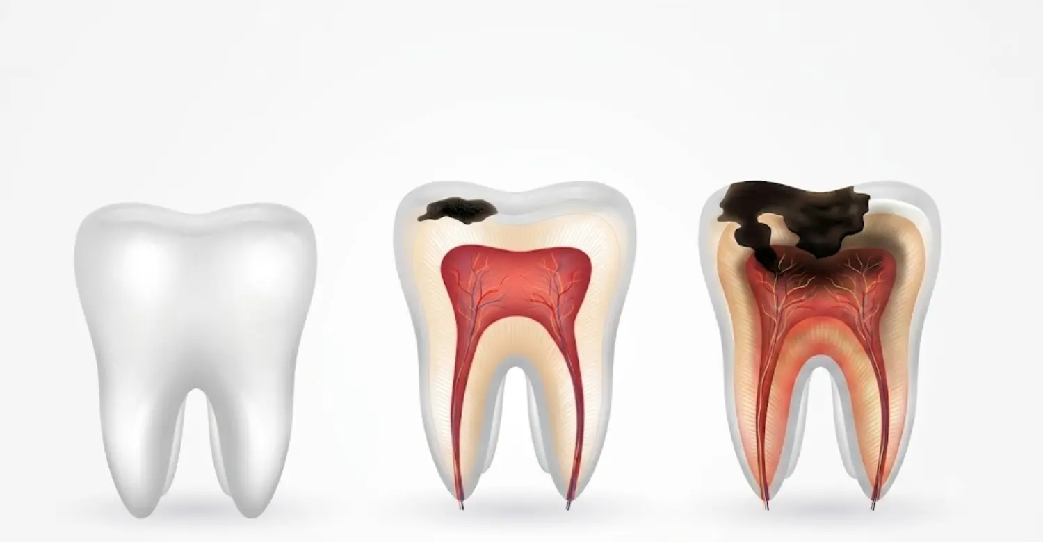 Tooth Decay vs Cavity 2